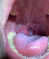 口蓋垂切除(LAUP)後の写真